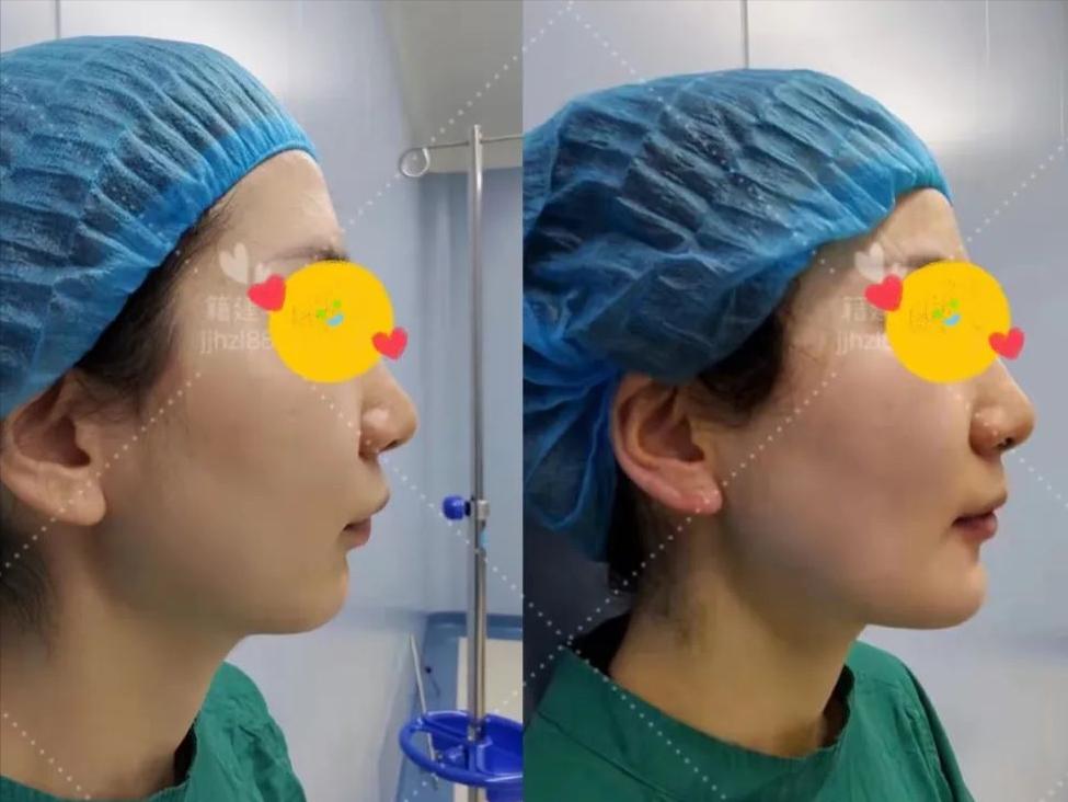 隆下巴假体用膨体好还是玻尿酸好,膨体隆下巴假体放的位置