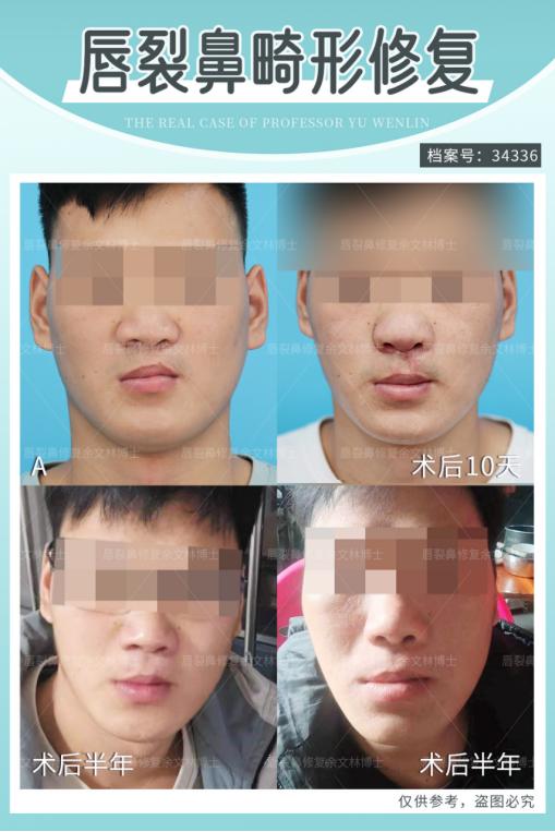 唇裂手术红唇裂开会自动愈合不,唇裂手术后伤口一直红怎么办