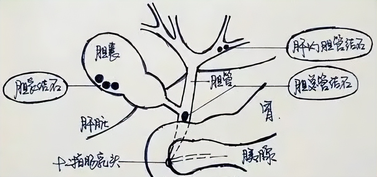 胆结石最佳治疗方法四川,胆结石怎么每天发作