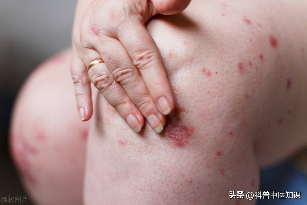 全身瘙痒中医辨证论治,全身瘙痒的中成药