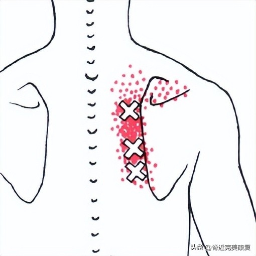 久卧背疼怎么办,总是背痛中医如何调理