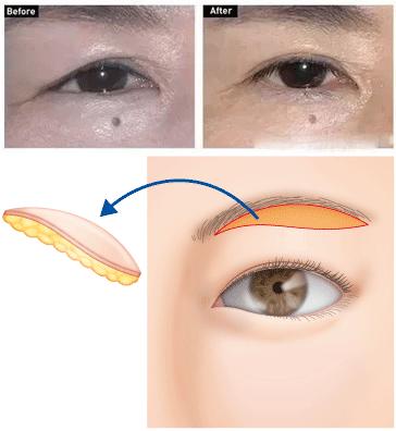 做完提眉和眼袋该注意些什么,做完提眉出现褶皱