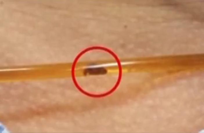 故事：湖北55岁男子病从口入，孕出成千上万虫卵，肚子竟成虫窝