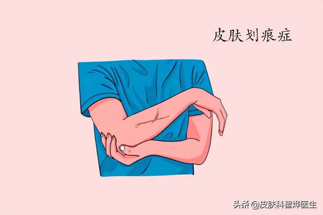 人工荨麻疹是什么原因造成的,人工荨麻疹是什么原因引起的