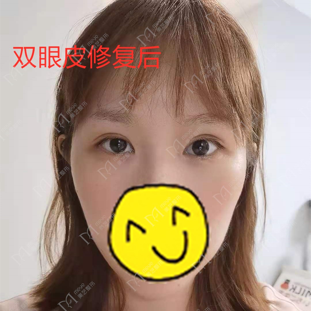我做了双眼皮下眼睑会肿怎么回事,做了双眼皮十天肉条感严重怎么办