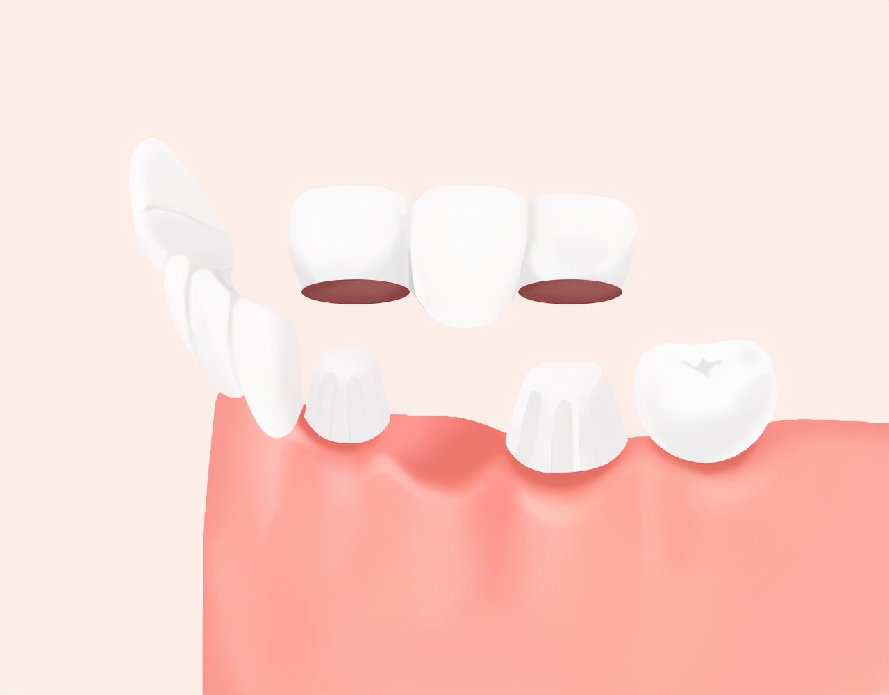老人假牙的种类及价格,假牙的种类及价格你知道吗