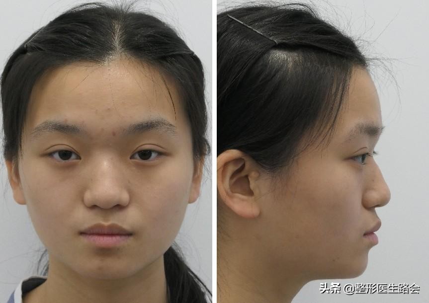 全脸整形记录恢复过程,女孩整形全过程