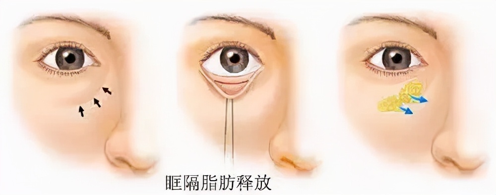 只需知道一招轻松消除显老泪沟,用什么办法能让泪沟修复