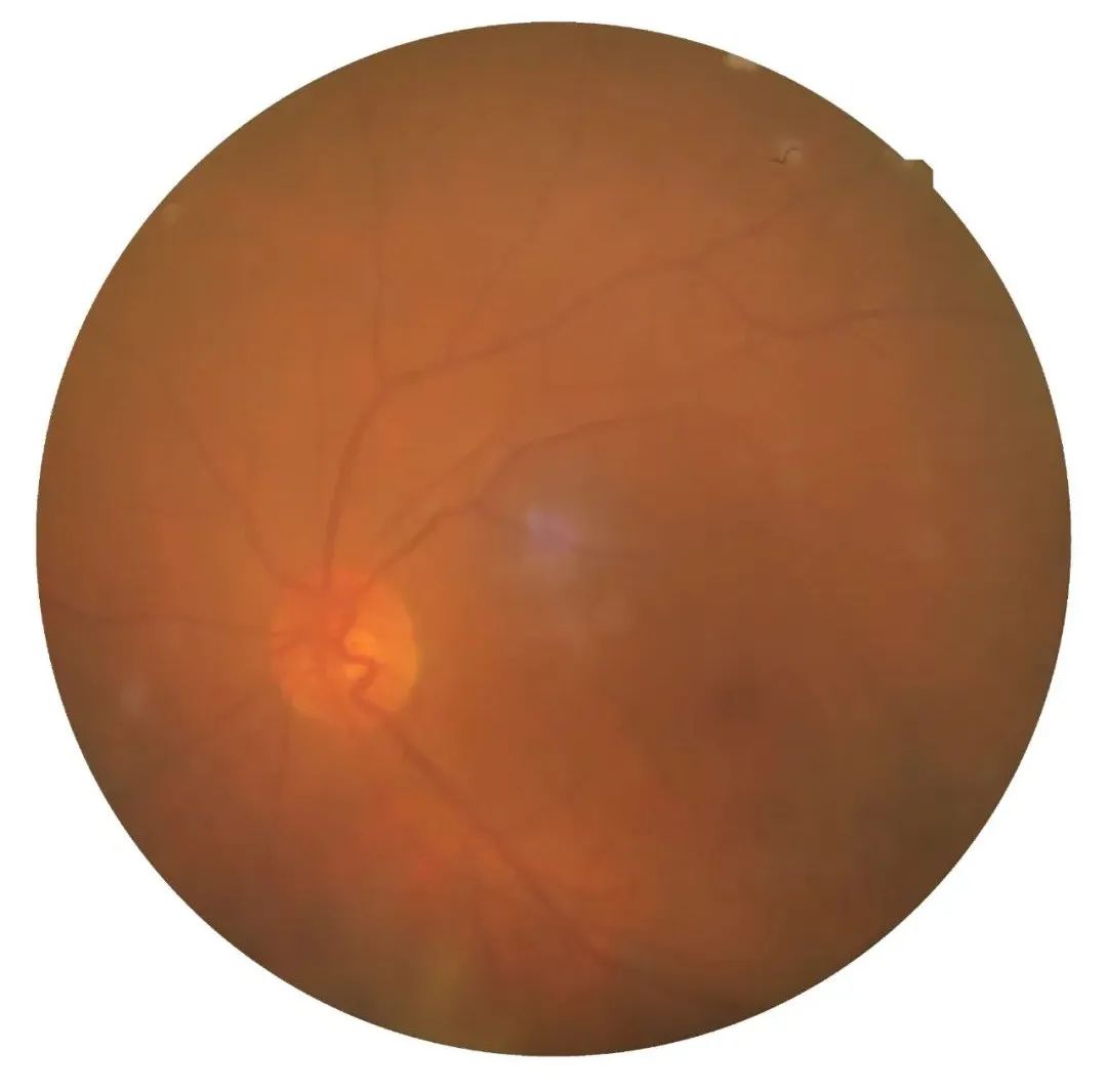 眼底出血术后忌什么中药,眼底出血中医有好办法吗