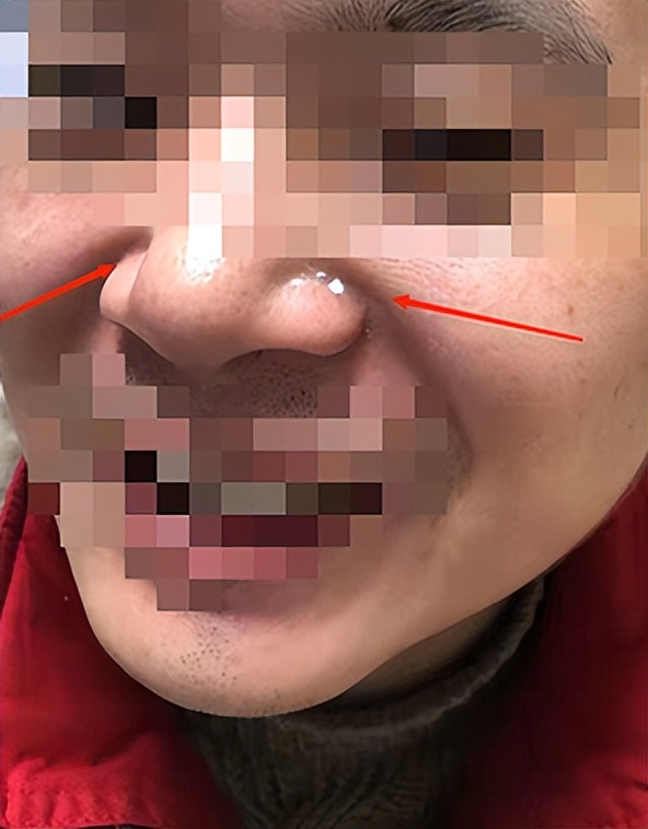 脸部红肿淌黄水是什么症状,脸上流黄水反复发作