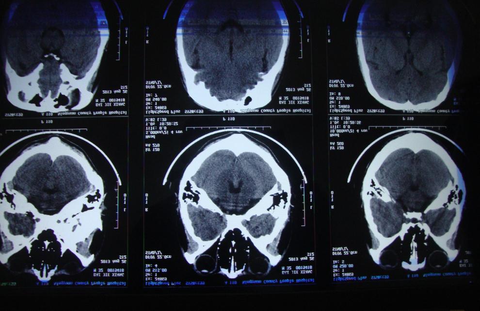 脑萎缩不可轻视应尽早防治,岁数大了脑萎缩吃什么药