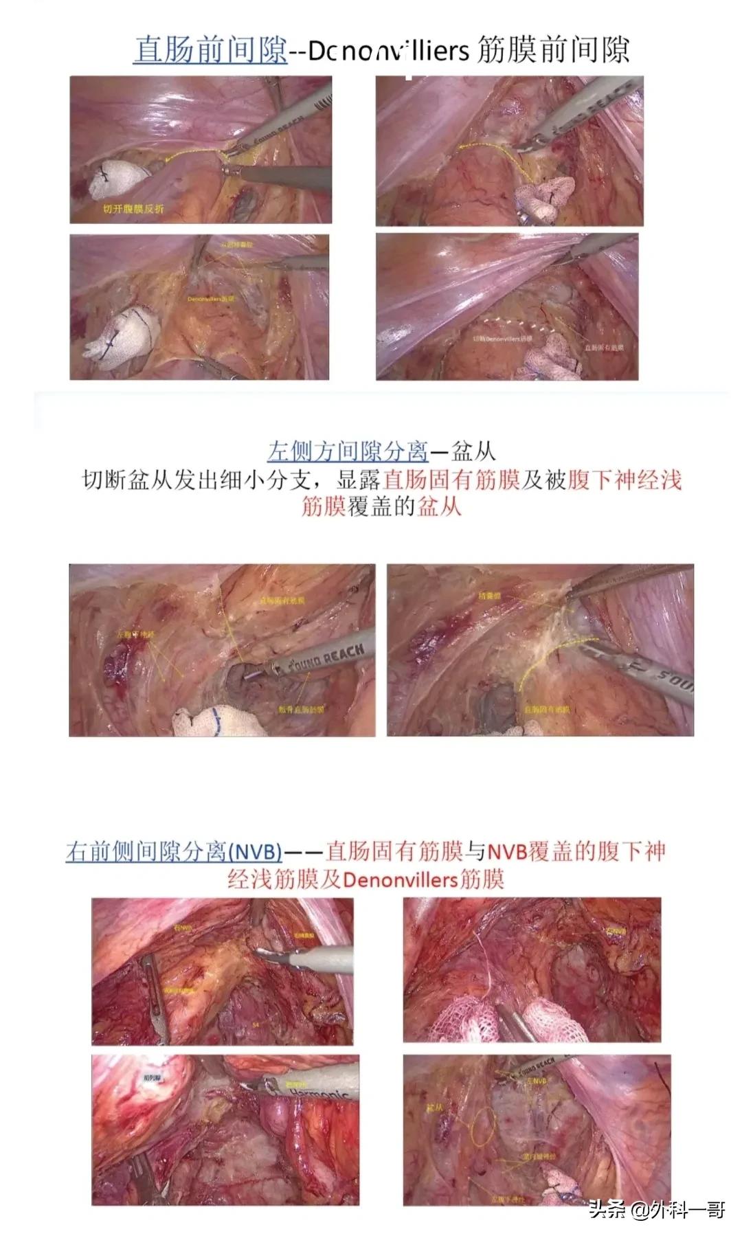 什么是直肠癌根治手术,直肠癌ESD手术