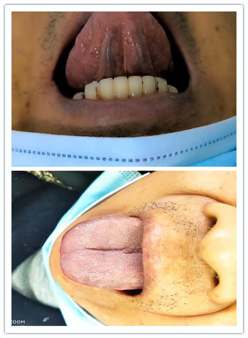 黄疸和肝衰竭有什么关系,肝衰竭黄疸人工肝后反弹