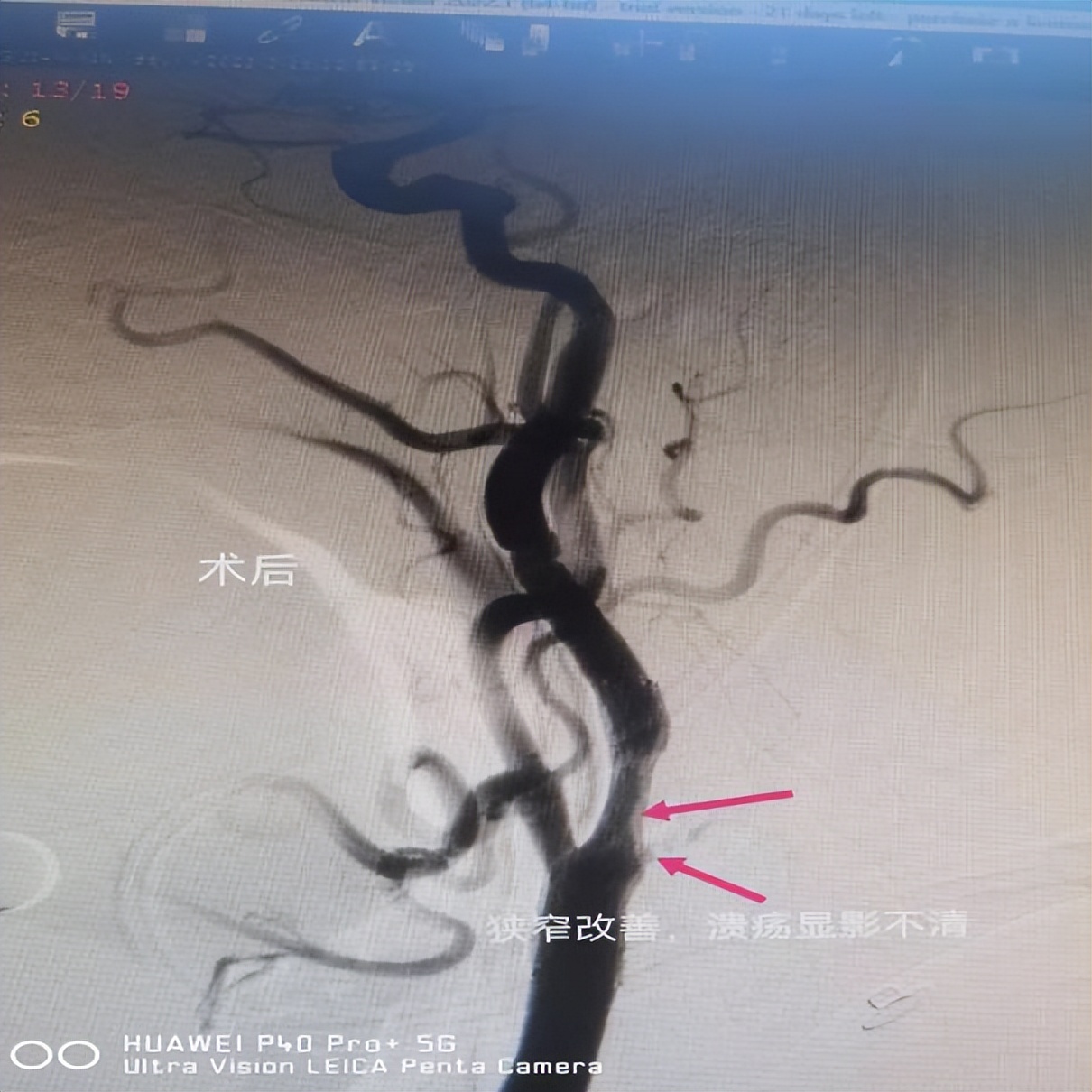 沣东院区脑病病区成功完成多例脑血管造影及颅内支架植入术