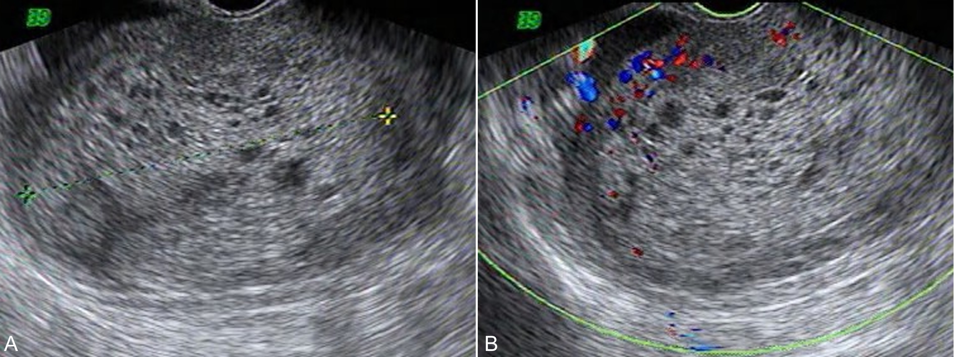 超声全身检查,超声诊断恶性葡萄胎