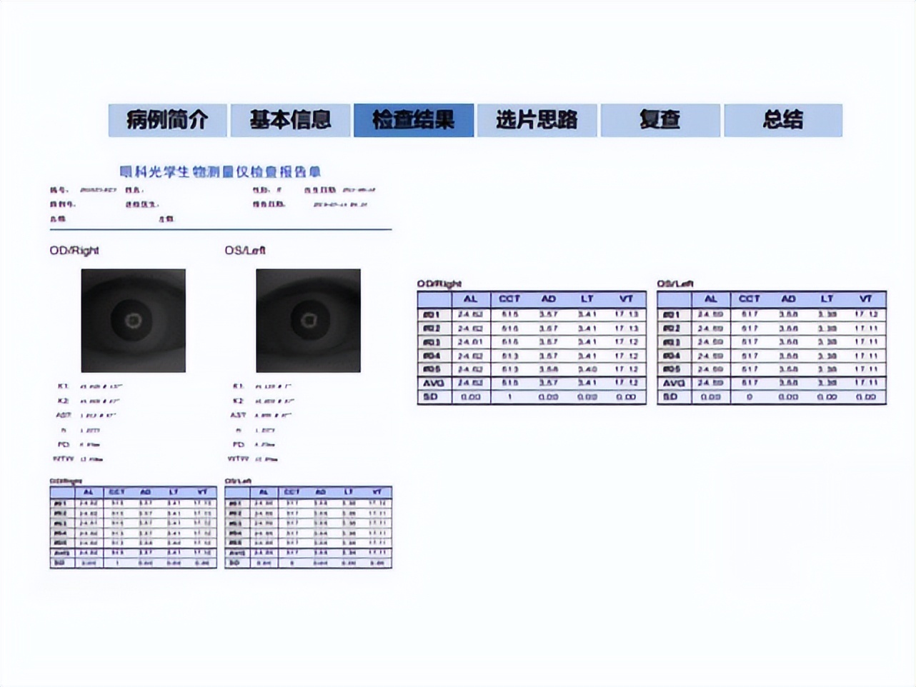 王凯角膜塑形镜原理,王凯医生塑形镜