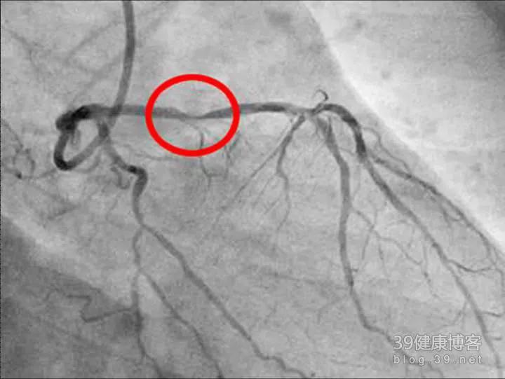 冠脉狭窄多少算是冠心病,冠脉狭窄超过50%可以诊断冠心病吗