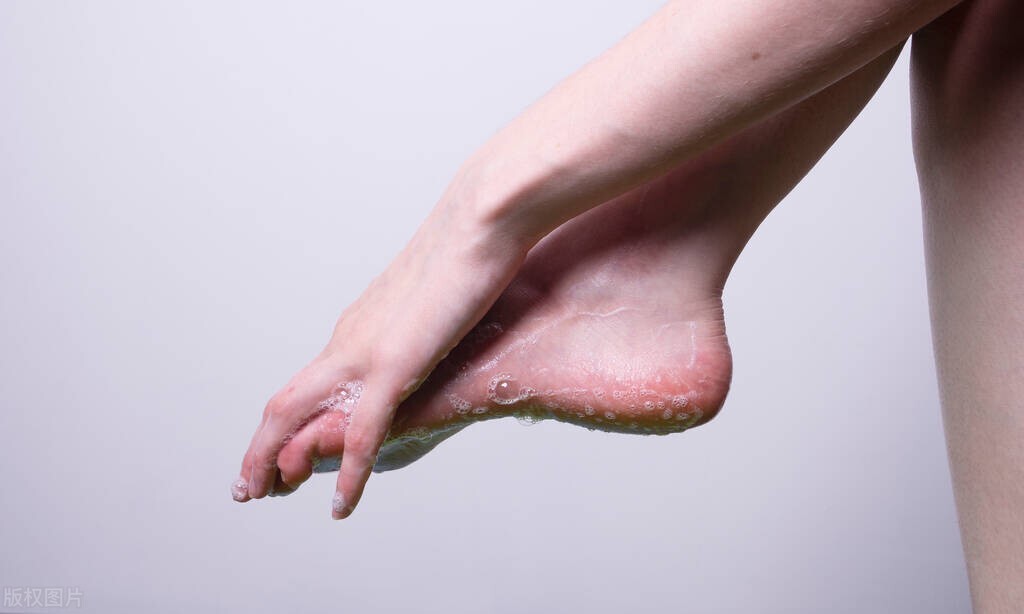脚气十多年怎么根治,脚气年年夏季复发怎么根除