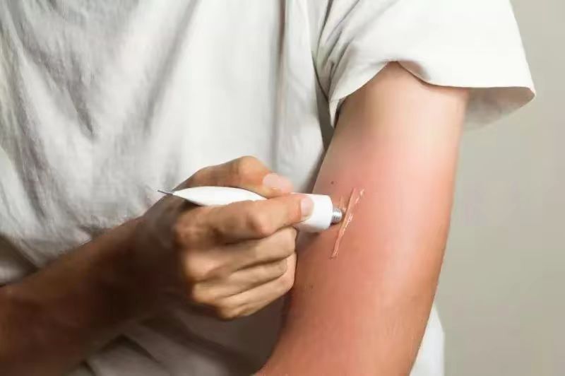 宝宝过敏起荨麻疹要不要挂急诊,宝宝得了荨麻疹需要忌口吗