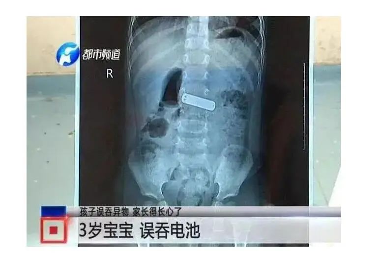 11个月大婴儿,吞下一枚3cm钉子!家长平时一定要收好家中小物品