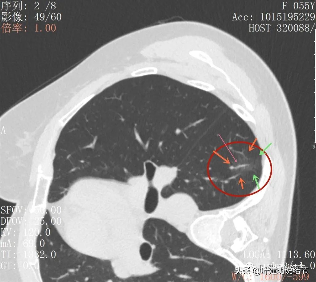 病例分享：这种样子的错构瘤？我是第一次见