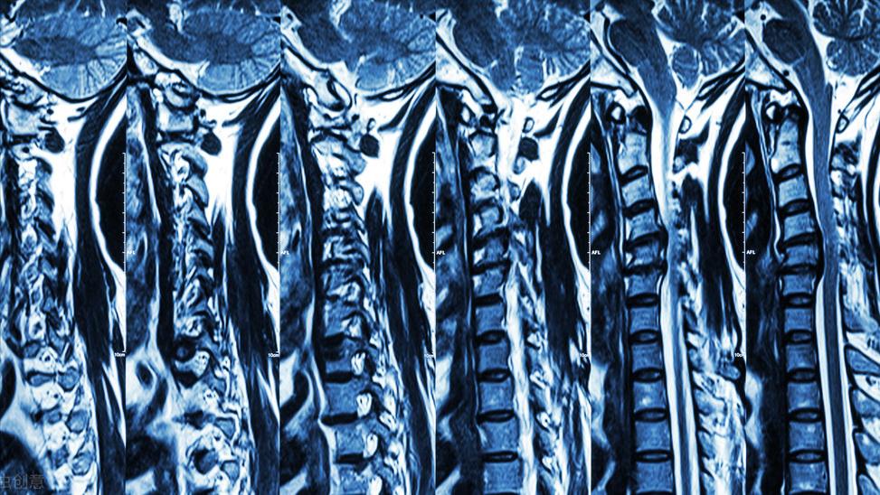 20岁腰5骶1椎间盘突出怎么办,十三岁腰椎间盘突出正常吗