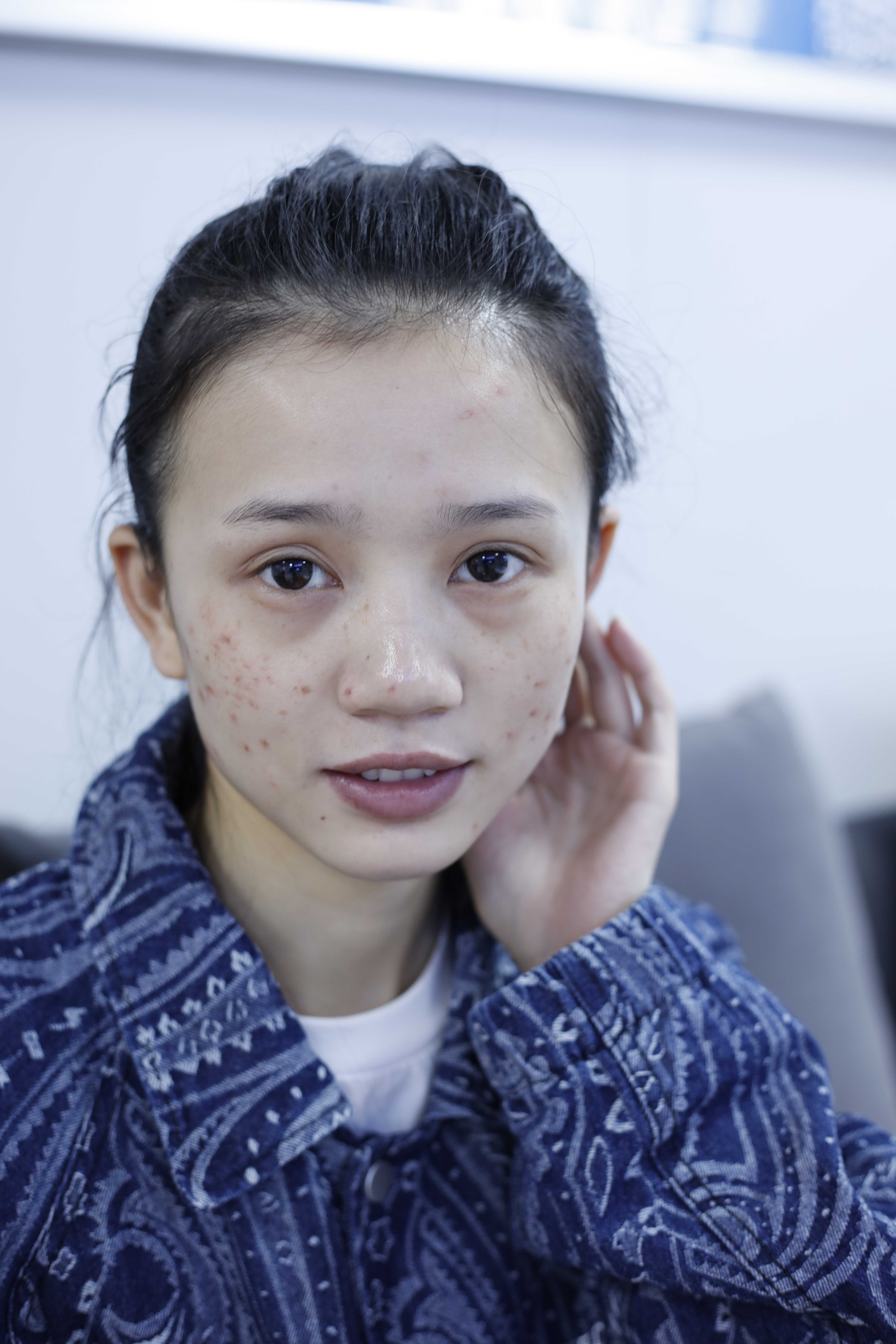 再漂亮的小姐姐也会被痘印困扰，治疗完后感叹激光治疗效果真不错