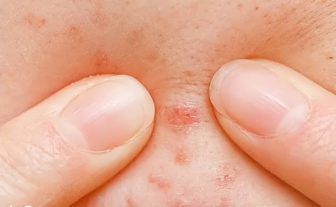 20岁突然开始长痘痘怎么调理,17岁了还长痘痘吗怎么治