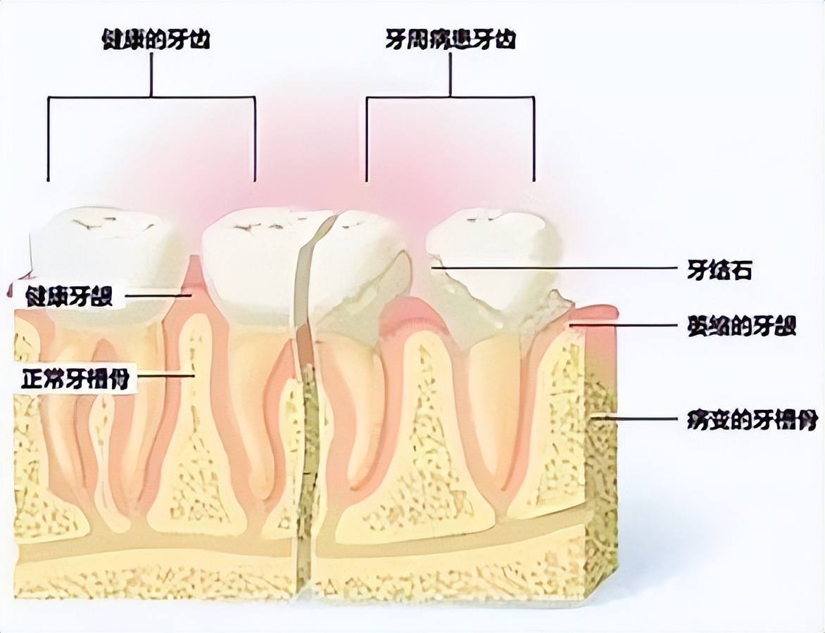 牙周病到底是什么样子的,牙周病是怎样出现的你知道吗