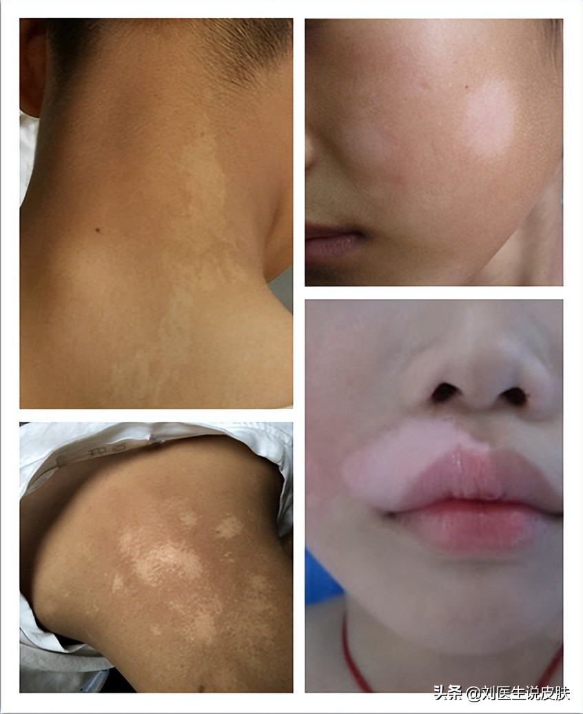 白癜风不扩散的白斑是白癜风吗,确诊白癜风出现白斑就是白癜风吗