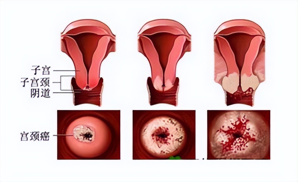 两任老婆患宫颈癌完整版,两任妻子得癌症