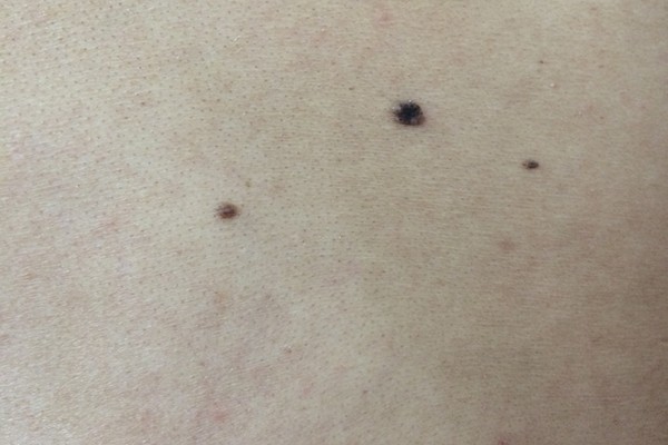 如何鉴别普通痣和黑色素瘤,如何分辨黑痣和黑色素瘤