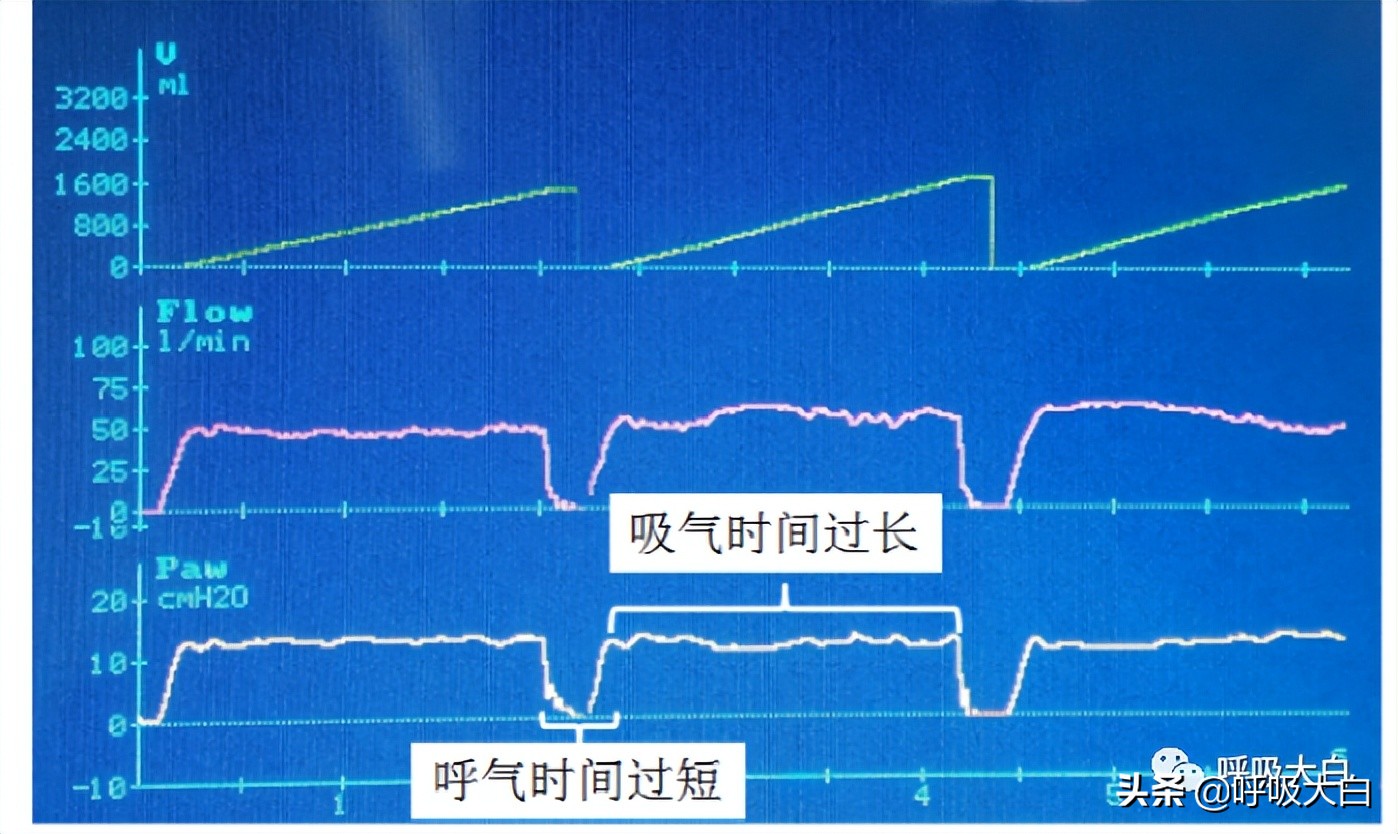 无创呼吸机与有创呼吸机设定区别,使用无创呼吸机时有哪些错误做法