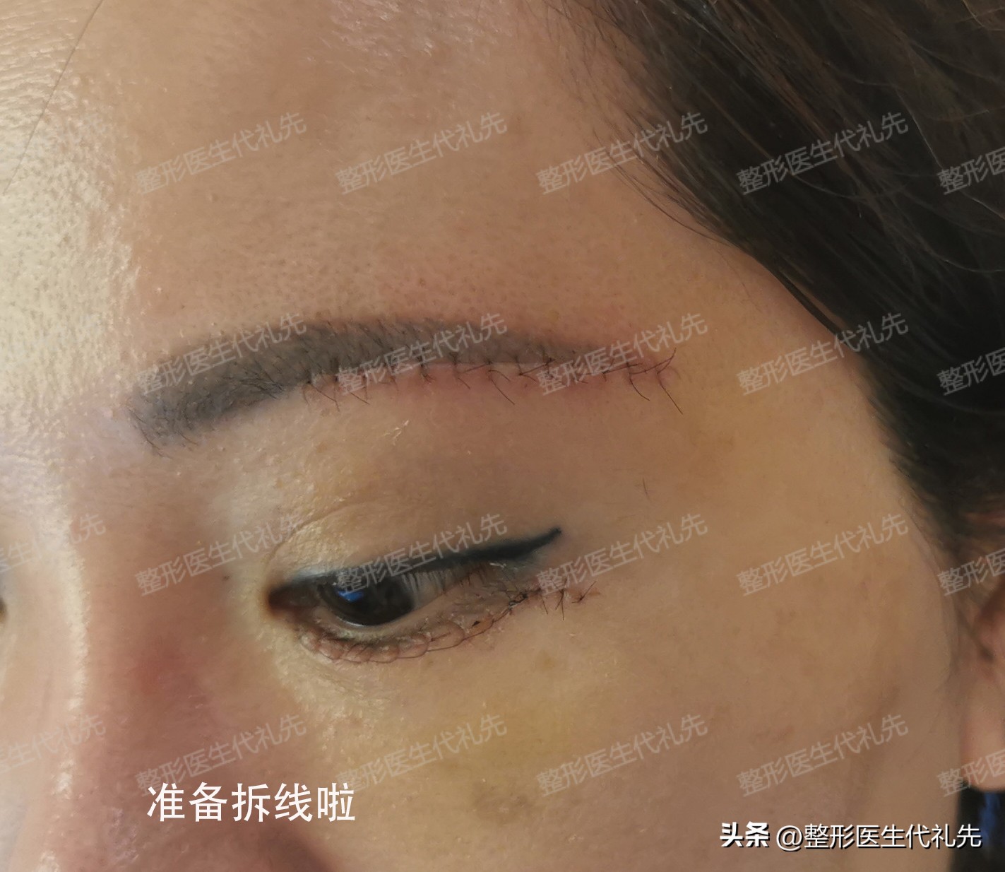 告别大眼袋其实不难,告别顽固大眼袋