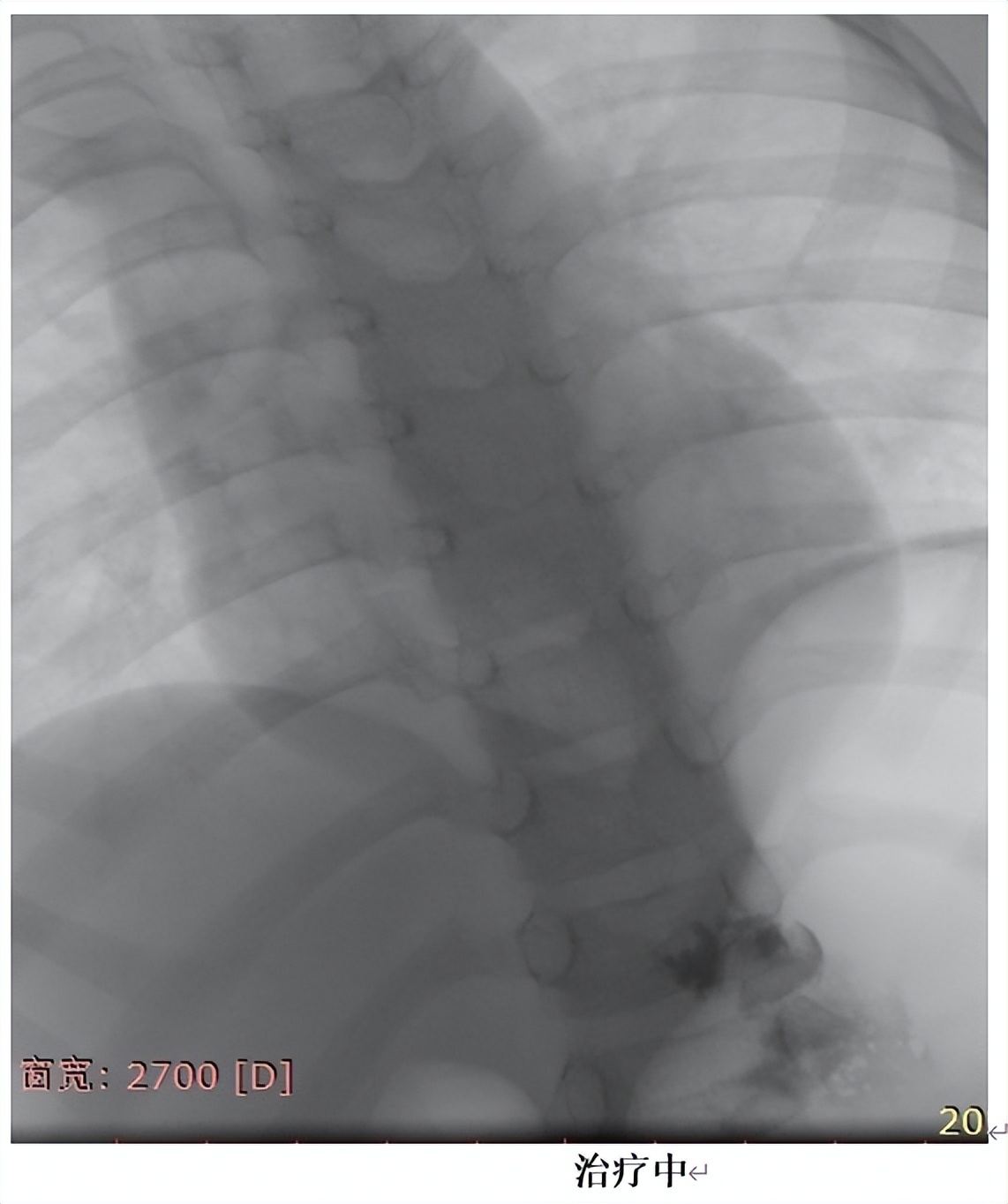淋巴管瘤的微创治疗,淋巴管瘤微创介入手术第二天