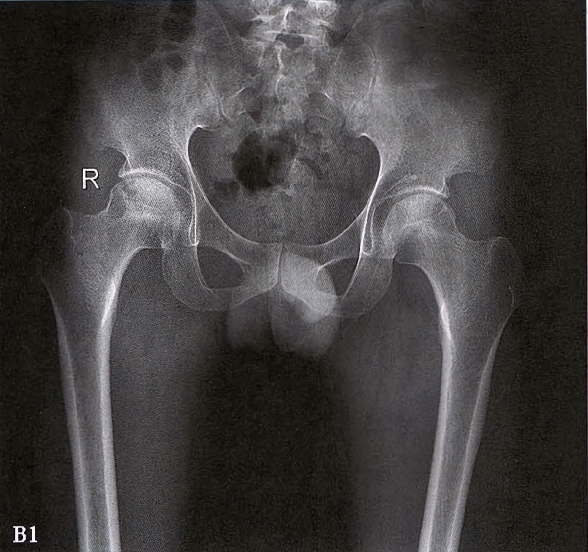 全国十大股骨头坏死诊疗中心,股骨头坏死诊疗方法有哪些