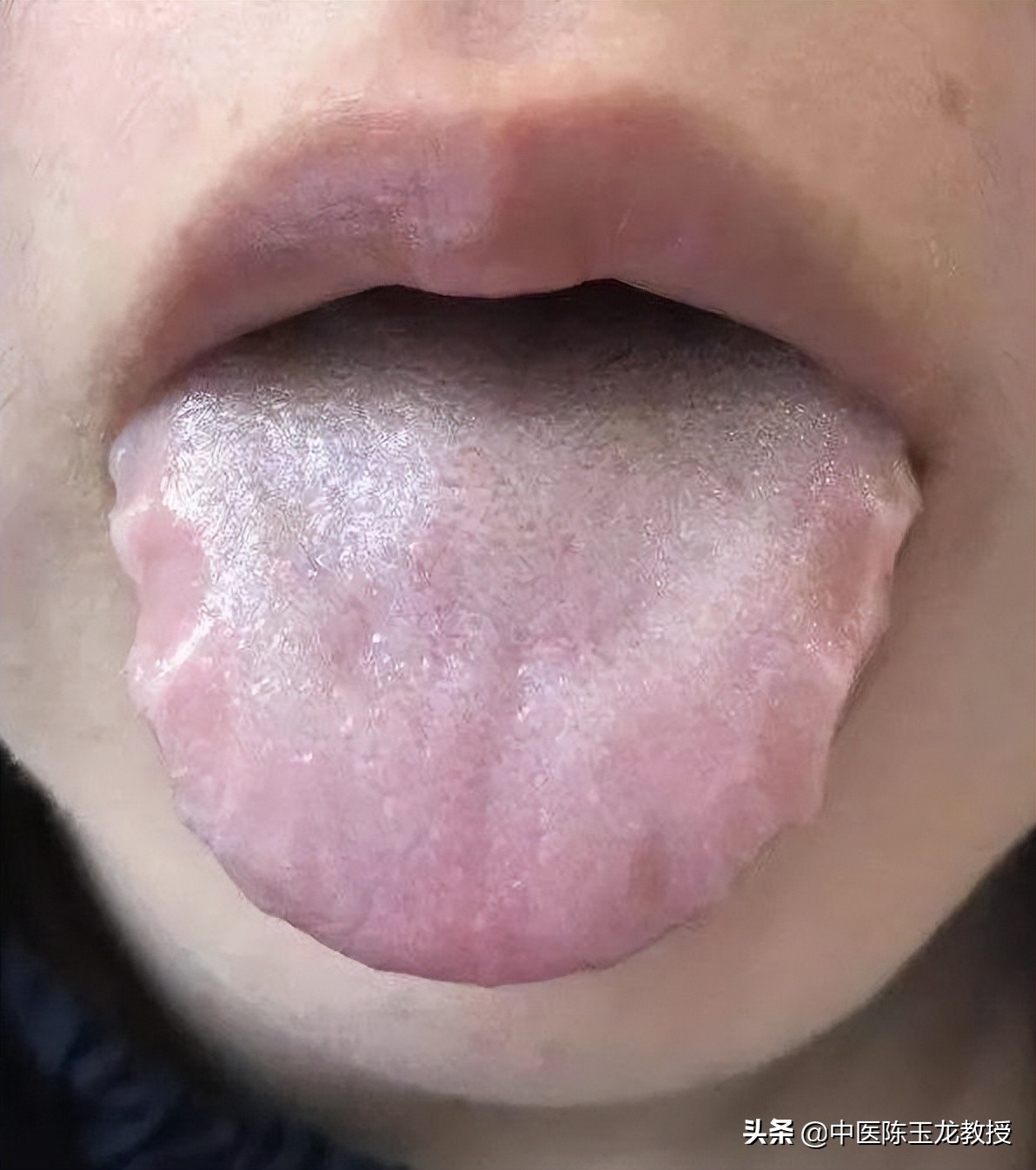 脾胃虚寒便溏肠鸣,脾胃湿热肠鸣泄泻注意事项