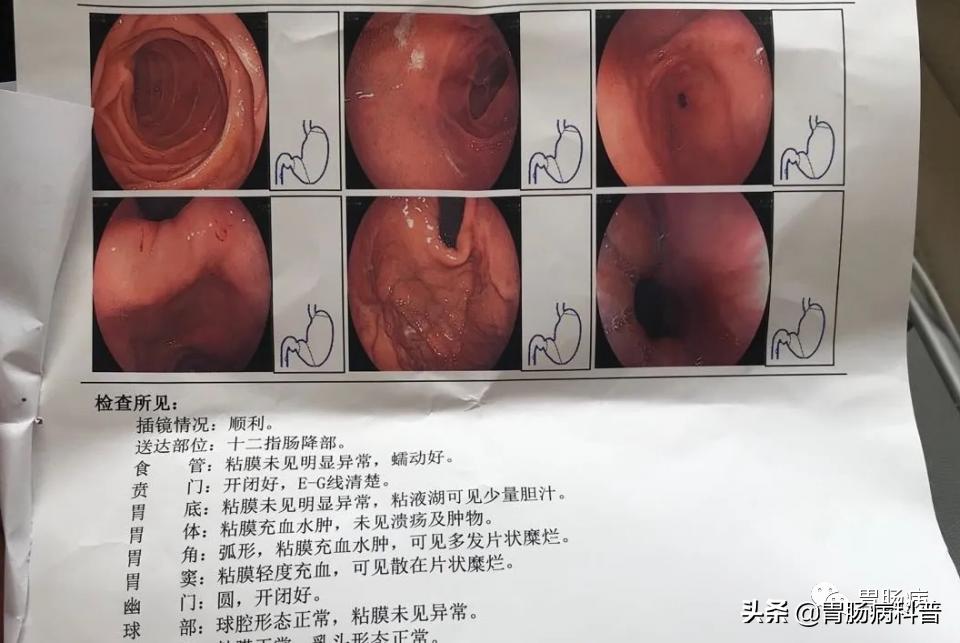 萎缩性胃炎伴肠化异型增生怎么办,萎缩性胃炎肠化及增生能逆转吗