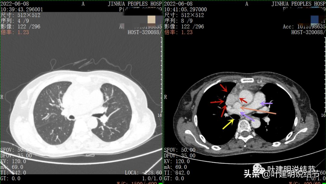 这位老乡，乏力来查，查出这么大个的纵隔肿瘤！会是什么呢？