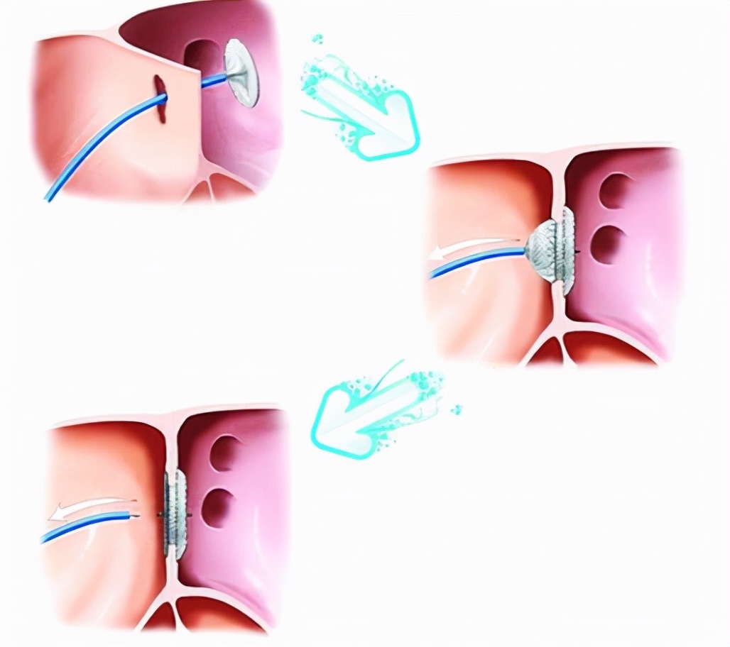 心脏手术疤痕一半增生一半没增生,心脏手术20年疤痕能修复吗