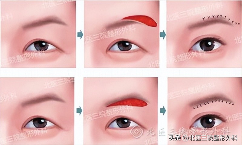 埋线双眼皮能解决皮肤松弛吗,单眼皮变成双眼皮是皮肤松弛了吗