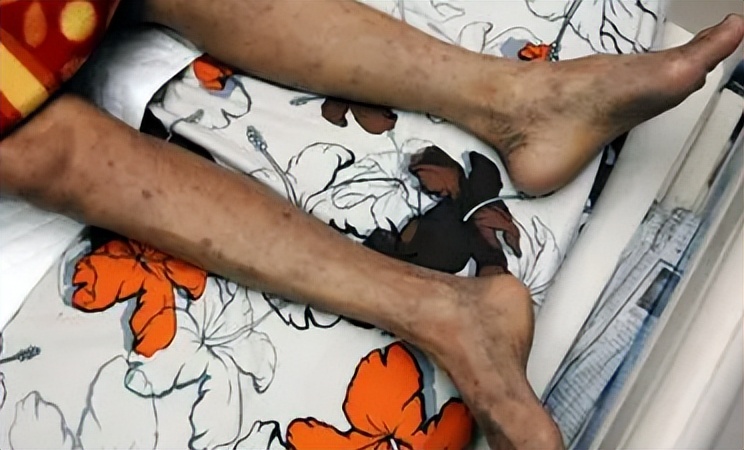 艾滋病不是病,有艾滋病的所有症状又是艾滋病吗