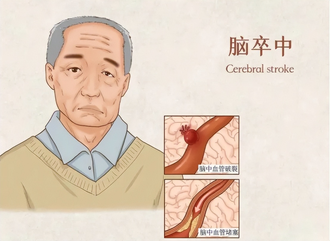 中风并发症会增加病死率，中医特色疗法针灸治疗效果如何？