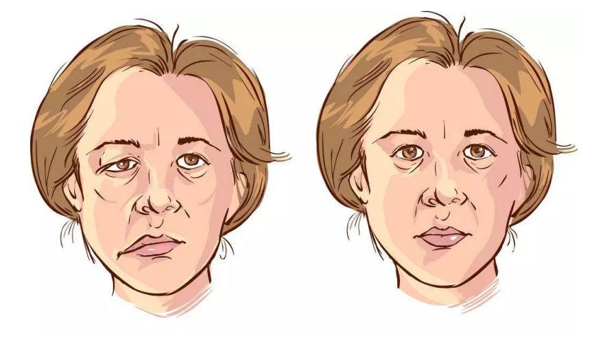 提醒：无端端有3种表现，十有八九是脑梗“求救”信号，尽早检查