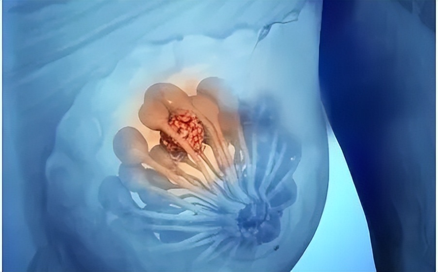 腋窝长了硬块是艾滋病吗,腋下有肿块有可能是艾滋病吗