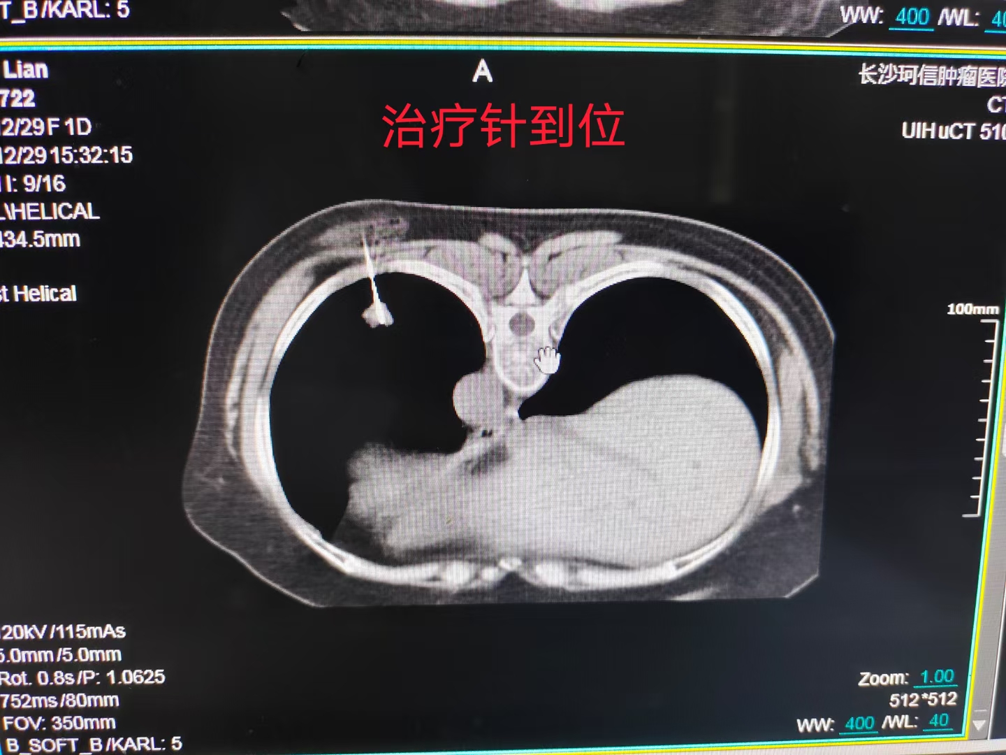 11厘米肺癌肿瘤粒子植入,肺癌多处转移放射治疗全过程