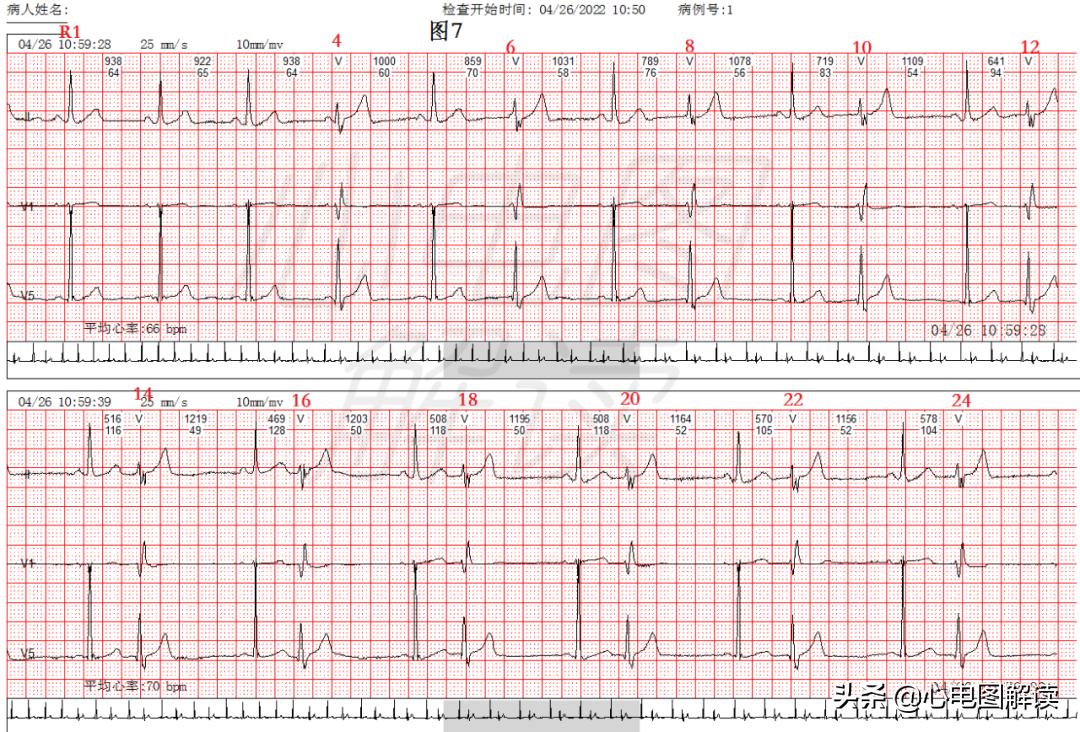 可见室性融合波是什么意思,室性融合波什么意思