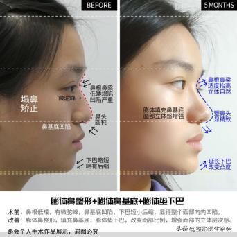 最让人显老的法令纹应该如何解决,法令纹和嘴角纹哪个更显老