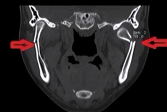 “下巴”外伤莫大意，警惕花式髁突骨折