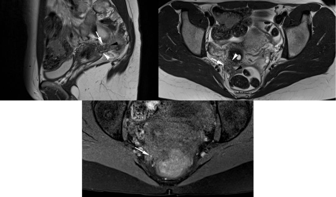 MRI如何评估子宫内膜异位症？这10个病例会帮助您